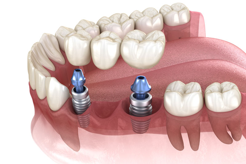 a dental implant bridge being held by two dental implants.