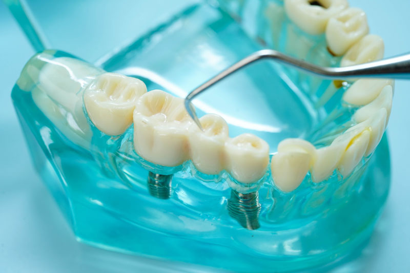 a dental implant thats placed into the jaw