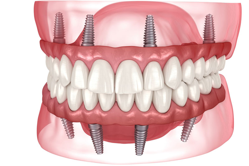 3D rendering of All-on-X dental implants with full arch implant-supported dentures attached to both upper and lower jaws.